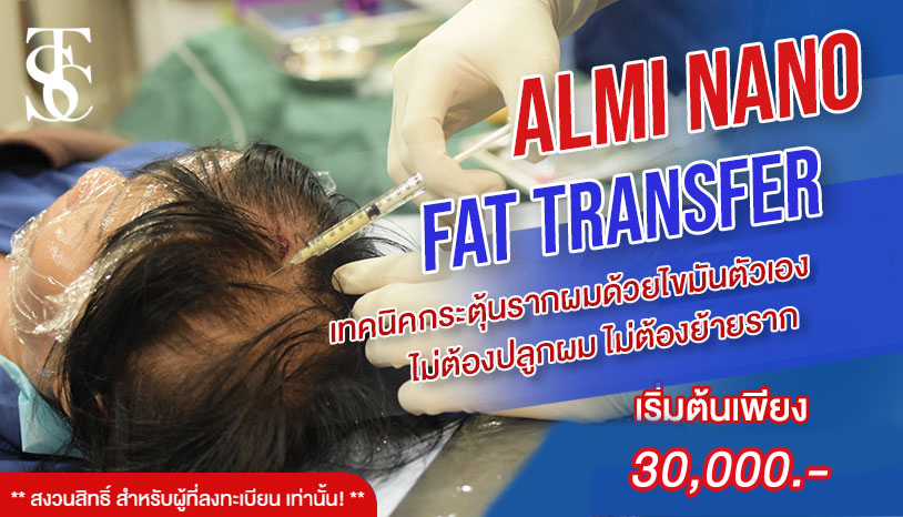 ALMI แก้30000