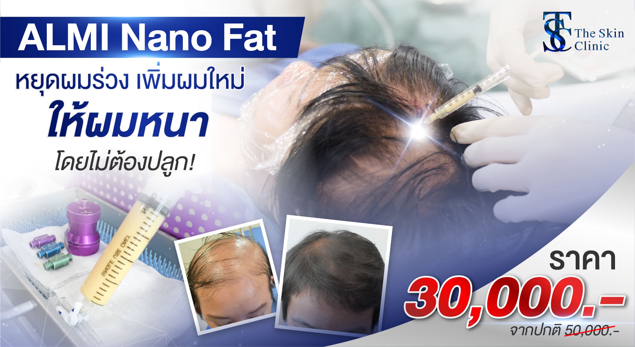 ALMI แก้30000