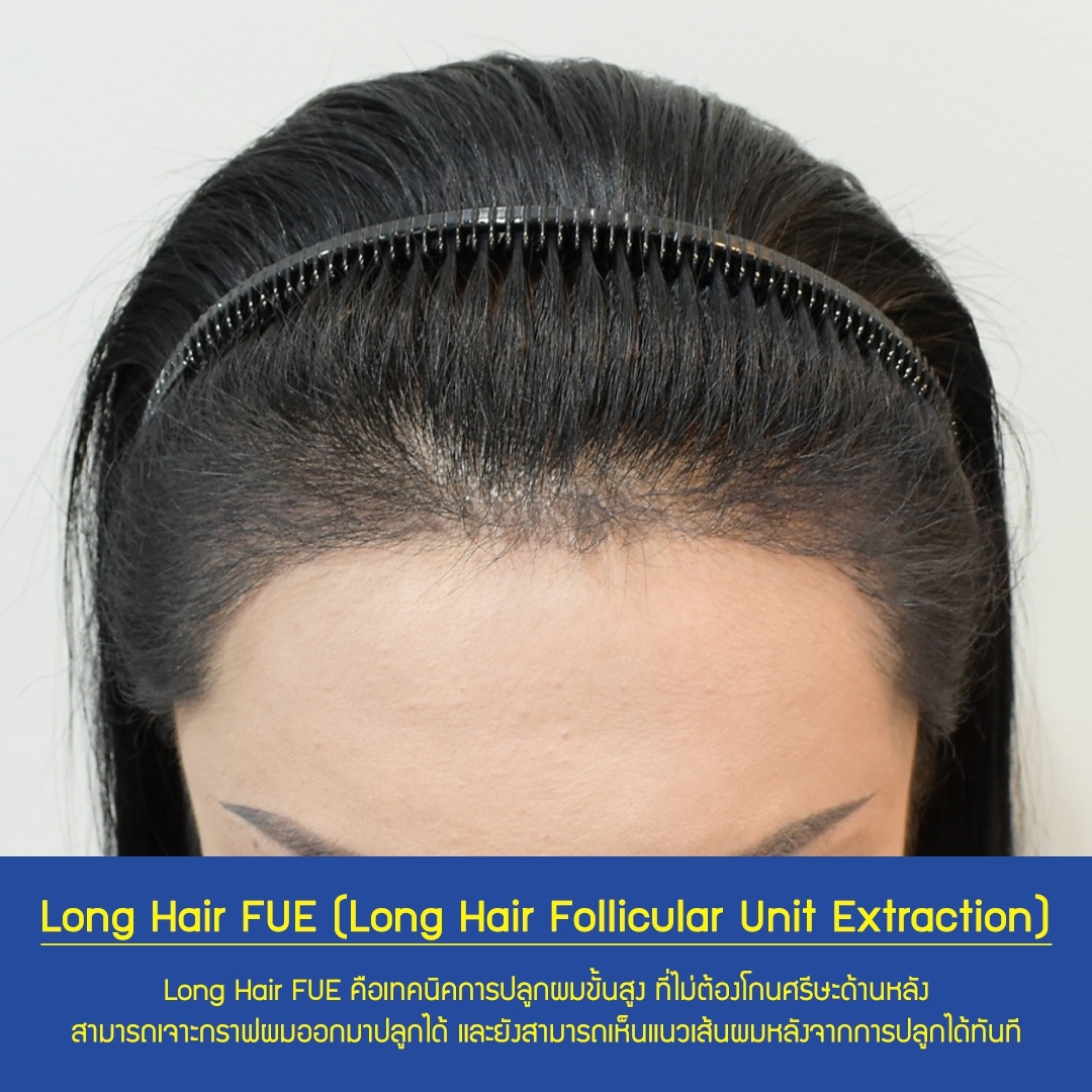 Female Hair Transplant