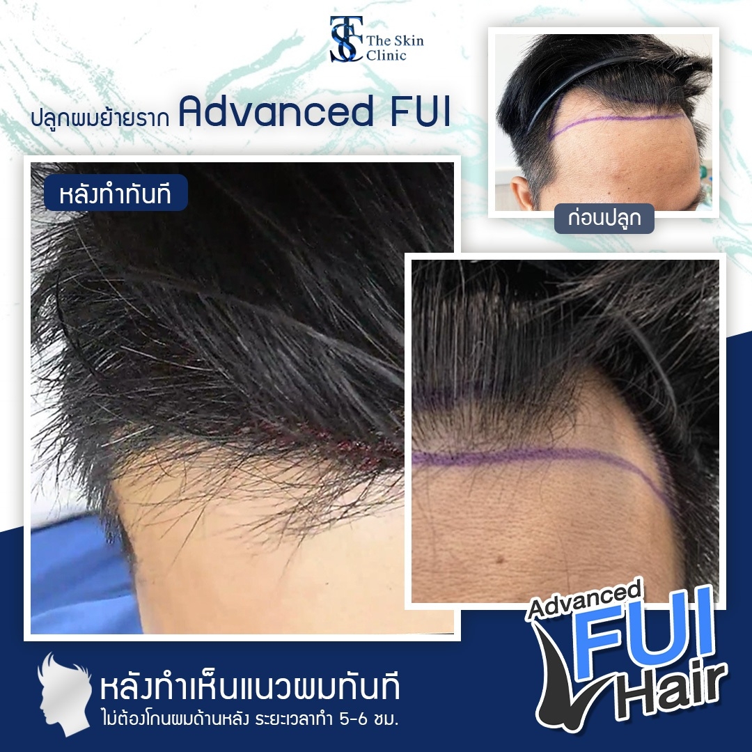 LINE ALBUM FUI Hair Review ๒๑๐๙๑๗