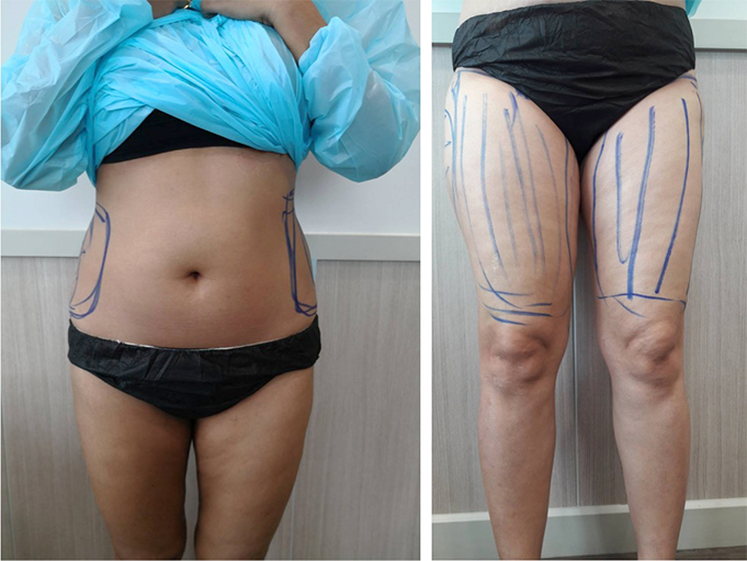 fat transfer 2