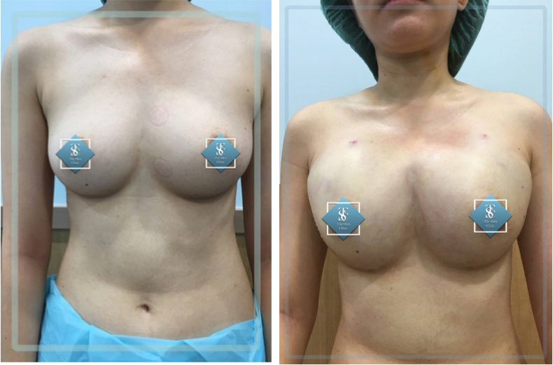 fat transfer 4