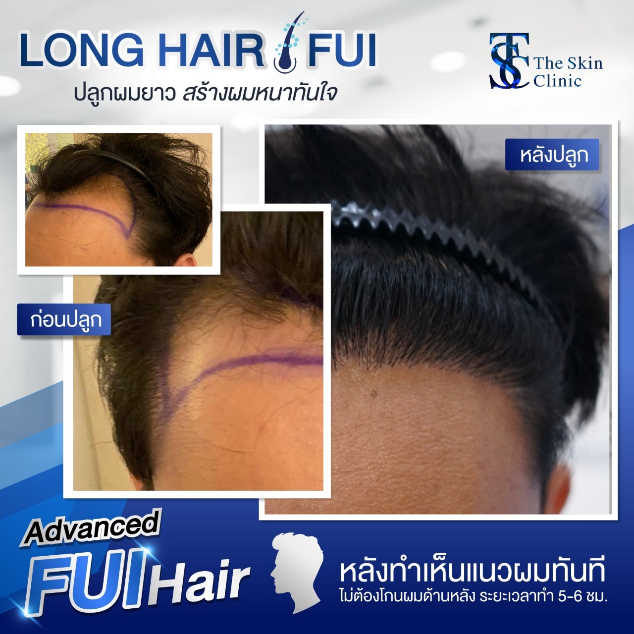 Long Hair FUE review2