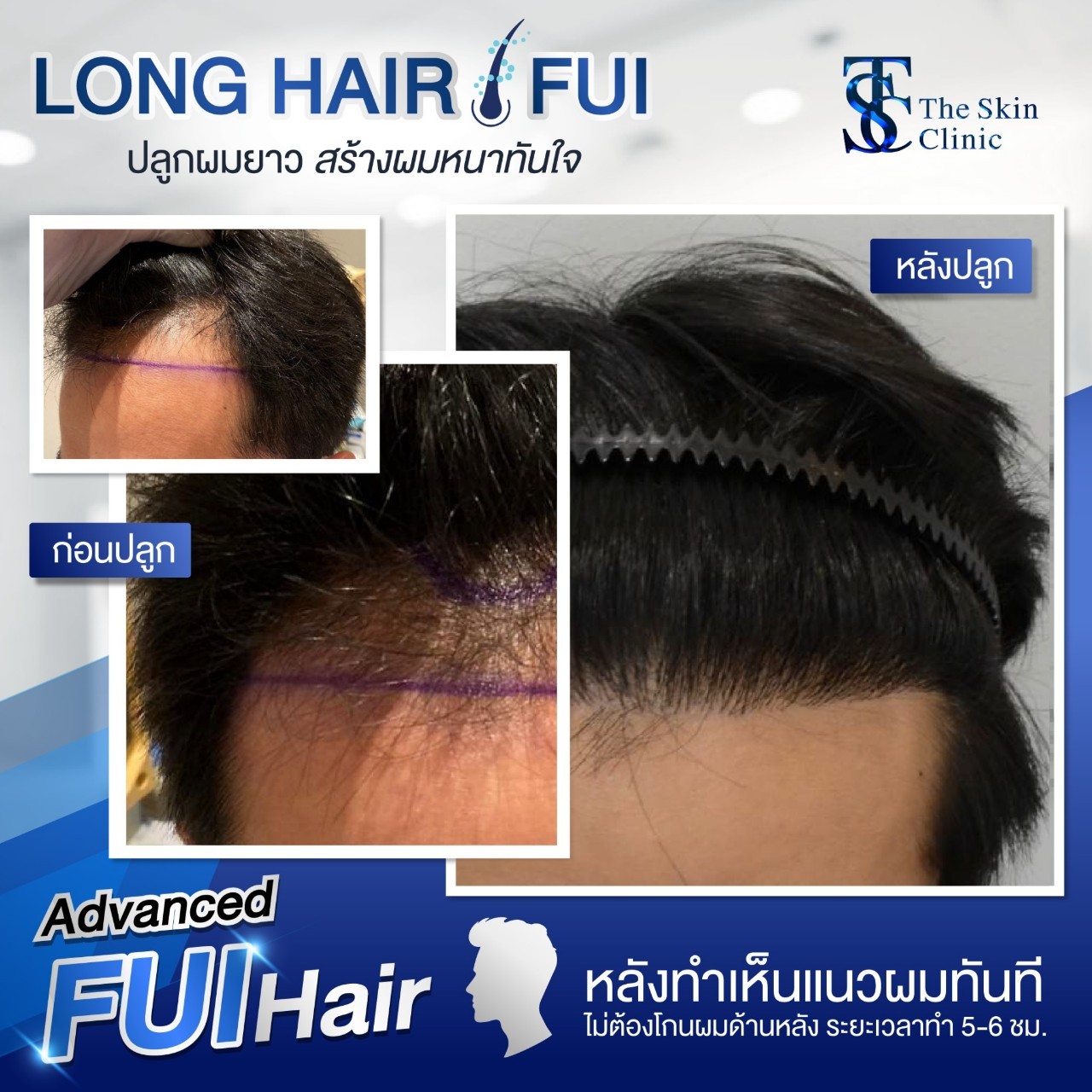 Long Hair FUE review1