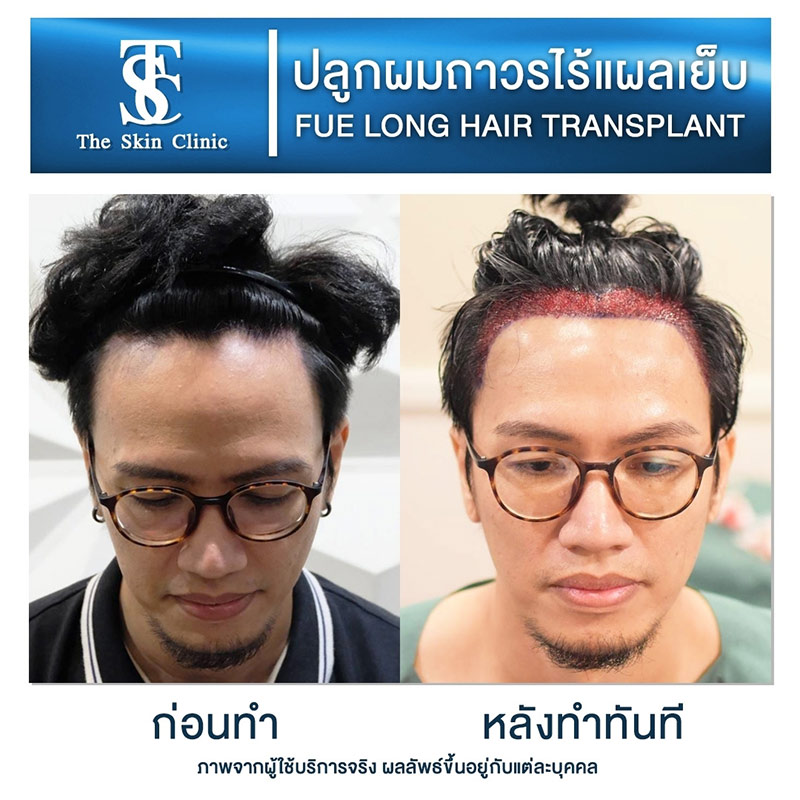 Long Hair FUE review1