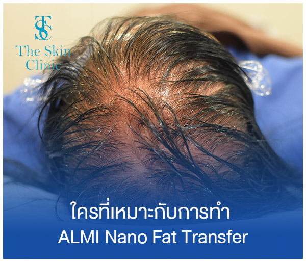 nano fat hair