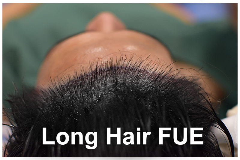  Long Hair FUE1